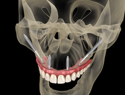 impianti dentali quando manca osso
